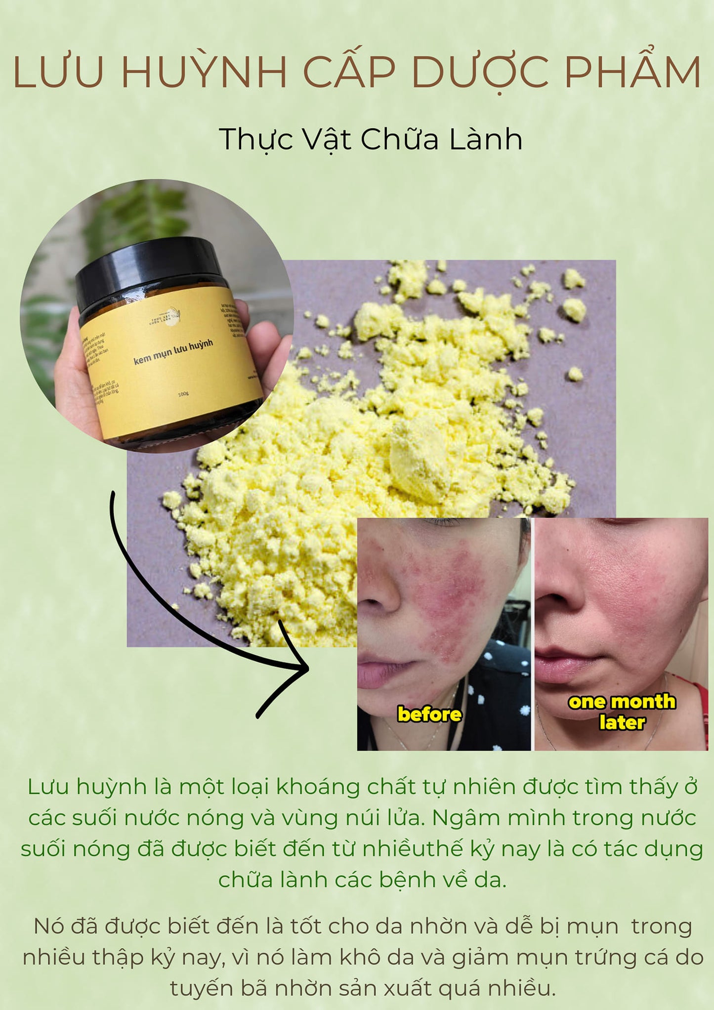 Kem Mụn Lưu Huỳnh